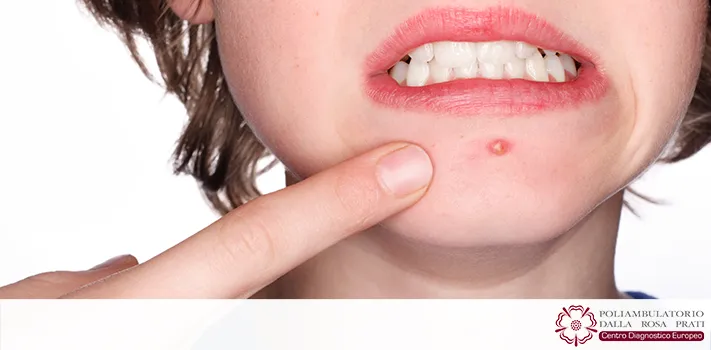 Cicatrici da acne? Rivolgiti al dermatologo 