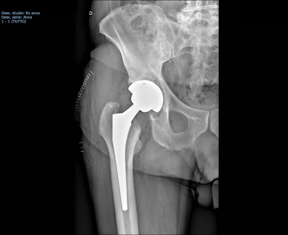 Super path: ultima evoluzione nella chirurgia protesica mini-invasiva dell’anca