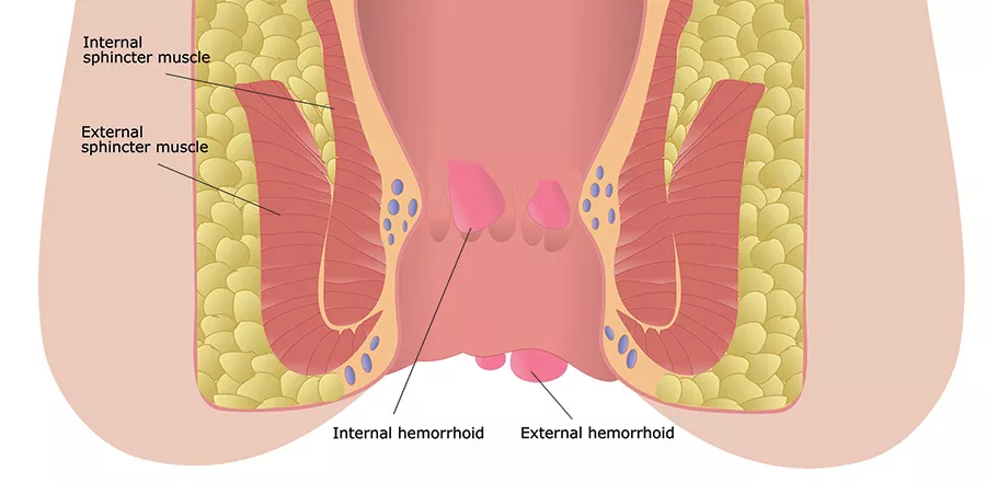 Le emorroidi