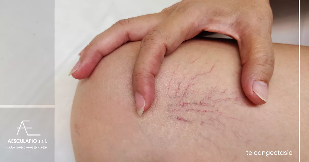 Capillari e vene varicose: laser o scleroterapia?