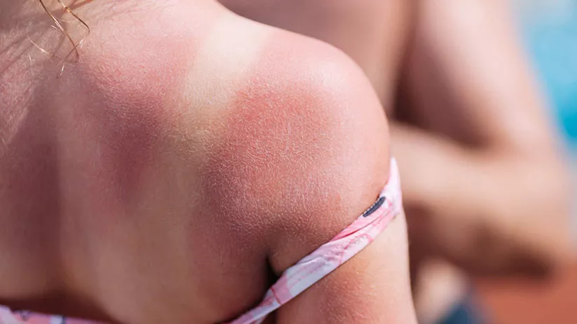 Prevenzione ustioni e colpi di calore: d’estate…