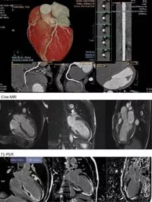 Newsletter Agosto: malattie cardiovascolari croniche e medicina di precisione