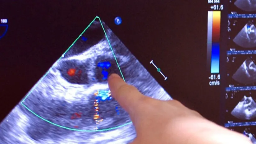Ecocolordoppler cardiaco da stress